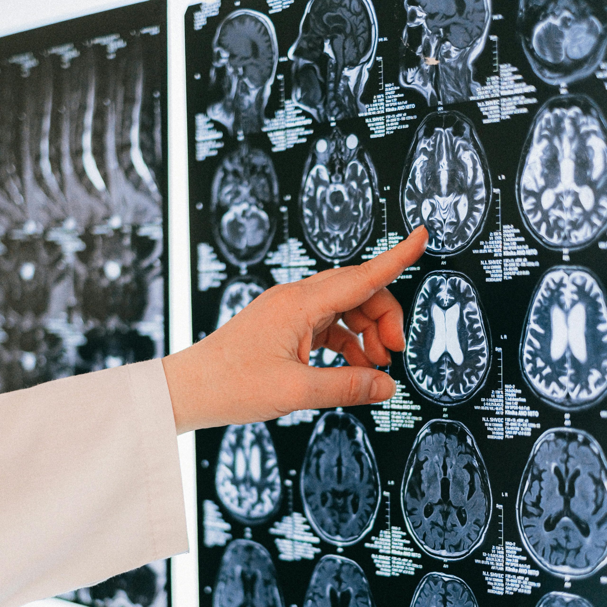 Radiologist pointing to brain MRI